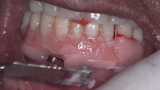 Bonded prostheses placed in the mouth, waiting for the final setting time of the acrylic resin. 