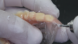 Removal of the prosthesis palate after the bite lock at the articulator.