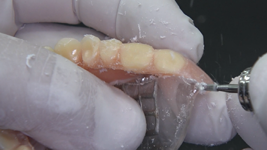 Removal of the prosthesis palate after the bite lock at the articulator.