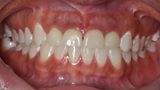 Clinical view of the provisionals five days after the surgery