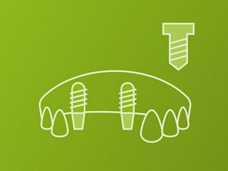 Plurale (vissé)