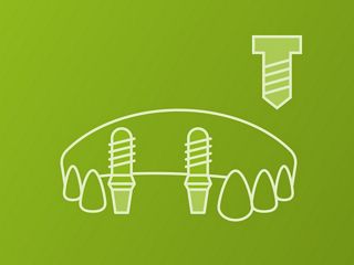 Plurale (vissé)