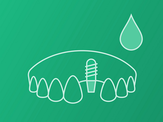 Single-tooth (Cement retained)