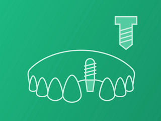 Single-tooth (Screw retained)