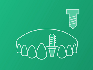 Single-tooth (Screw retained)